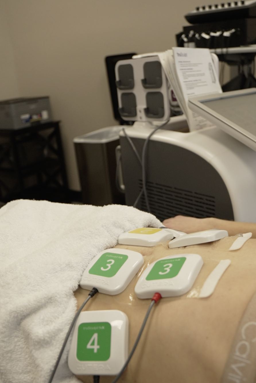 TruFlex EMS electrode pads on abdomen CT Medical Weight Loss and Beyond